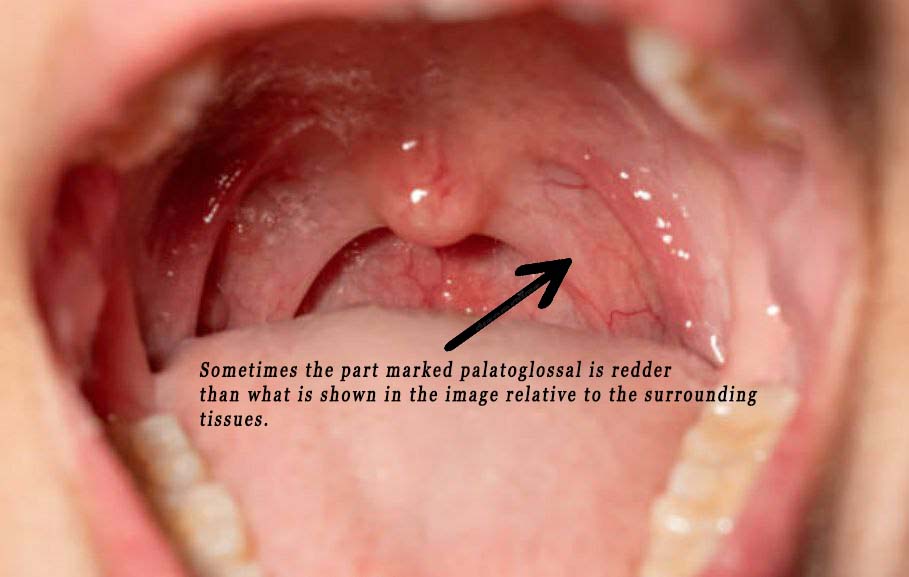 Palatoglossal Arch Discoloration